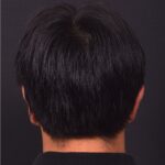 Otoplasty Atlanta ear pinning surgery before after results best near me plastic surgeon collagen earlobe
