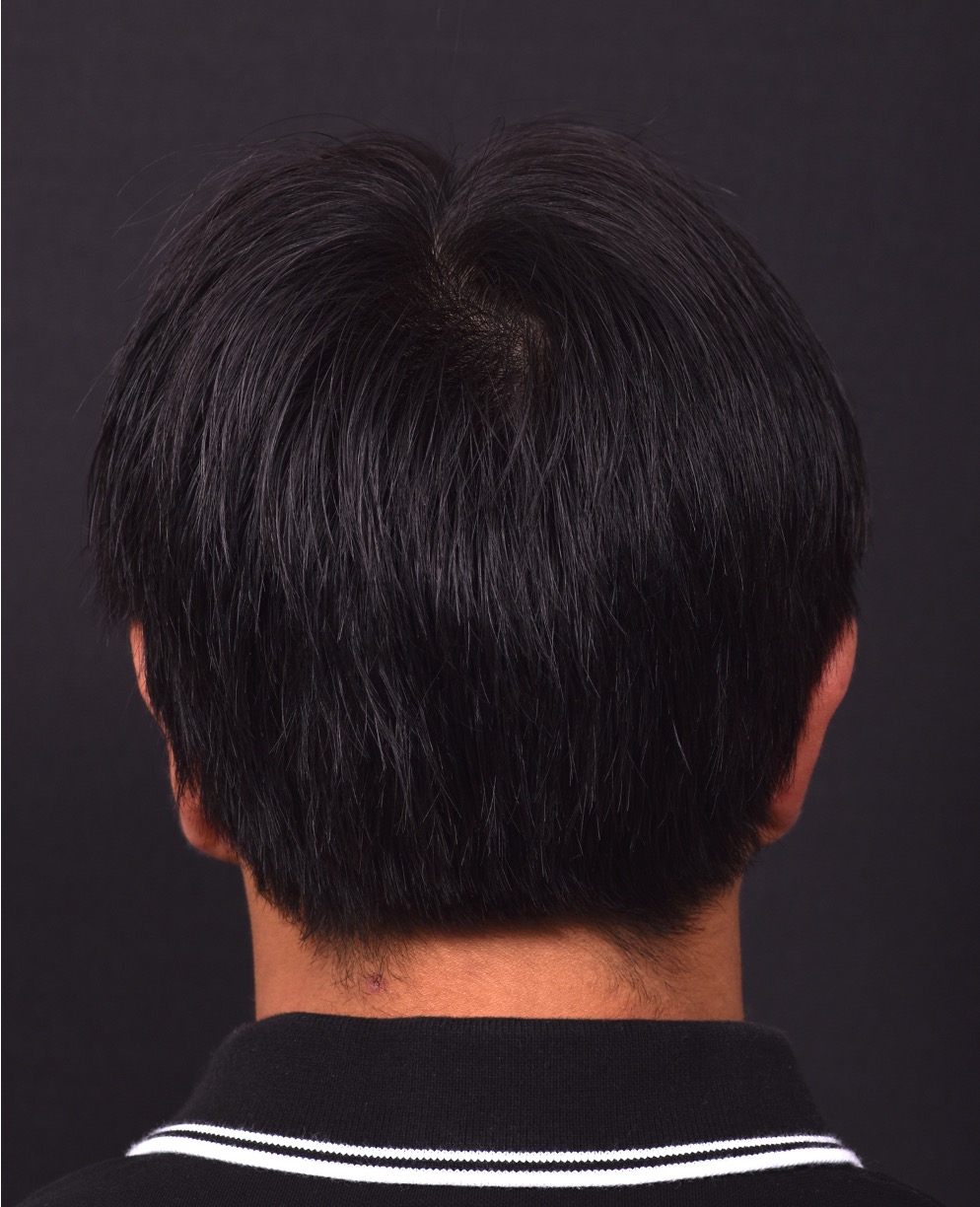 Otoplasty Atlanta ear pinning surgery before after results best near me plastic surgeon collagen earlobe