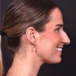 Rhinoplasty piezo ultrasonic preservation best expert near me Atlanta septoplasty nose job before after collagen