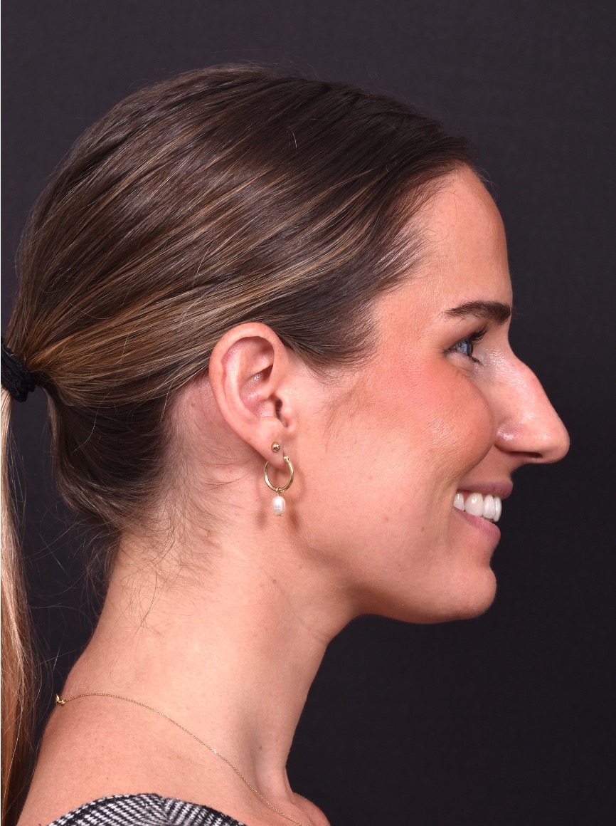 Rhinoplasty piezo ultrasonic preservation best expert near me Atlanta septoplasty nose job before after collagen