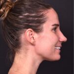 Rhinoplasty piezo ultrasonic preservation best expert near me Atlanta septoplasty nose job before after collagen