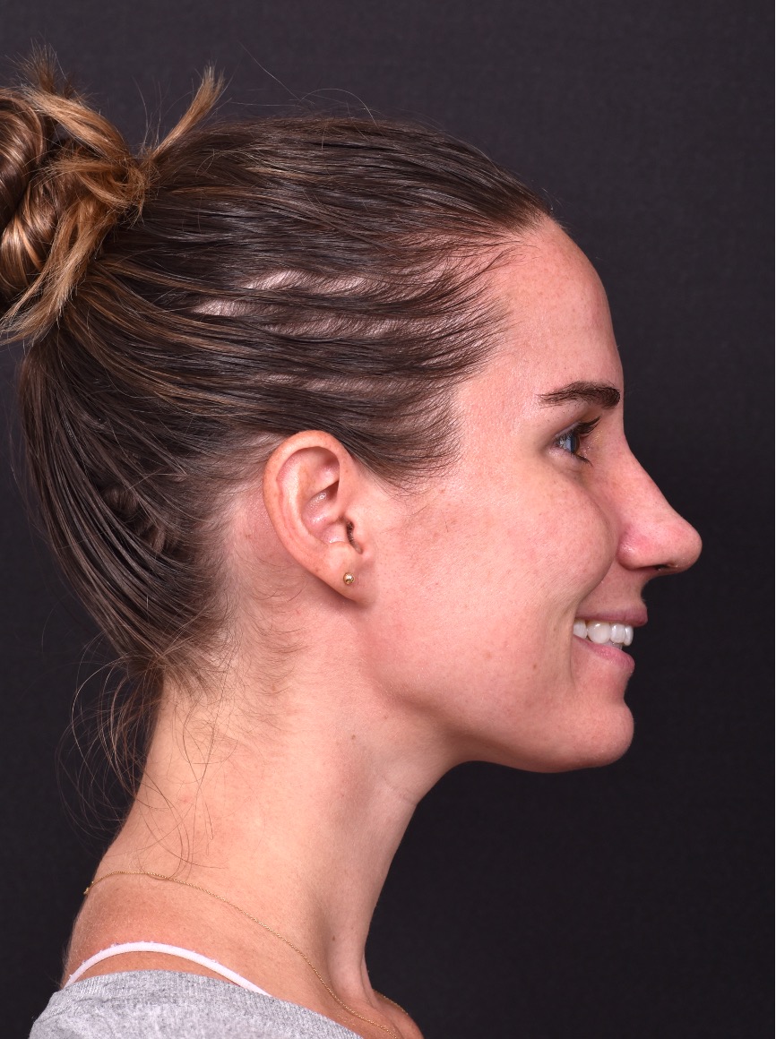 Rhinoplasty piezo ultrasonic preservation best expert near me Atlanta septoplasty nose job before after collagen