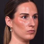 Rhinoplasty piezo ultrasonic preservation best expert near me Atlanta septoplasty nose job before after collagen