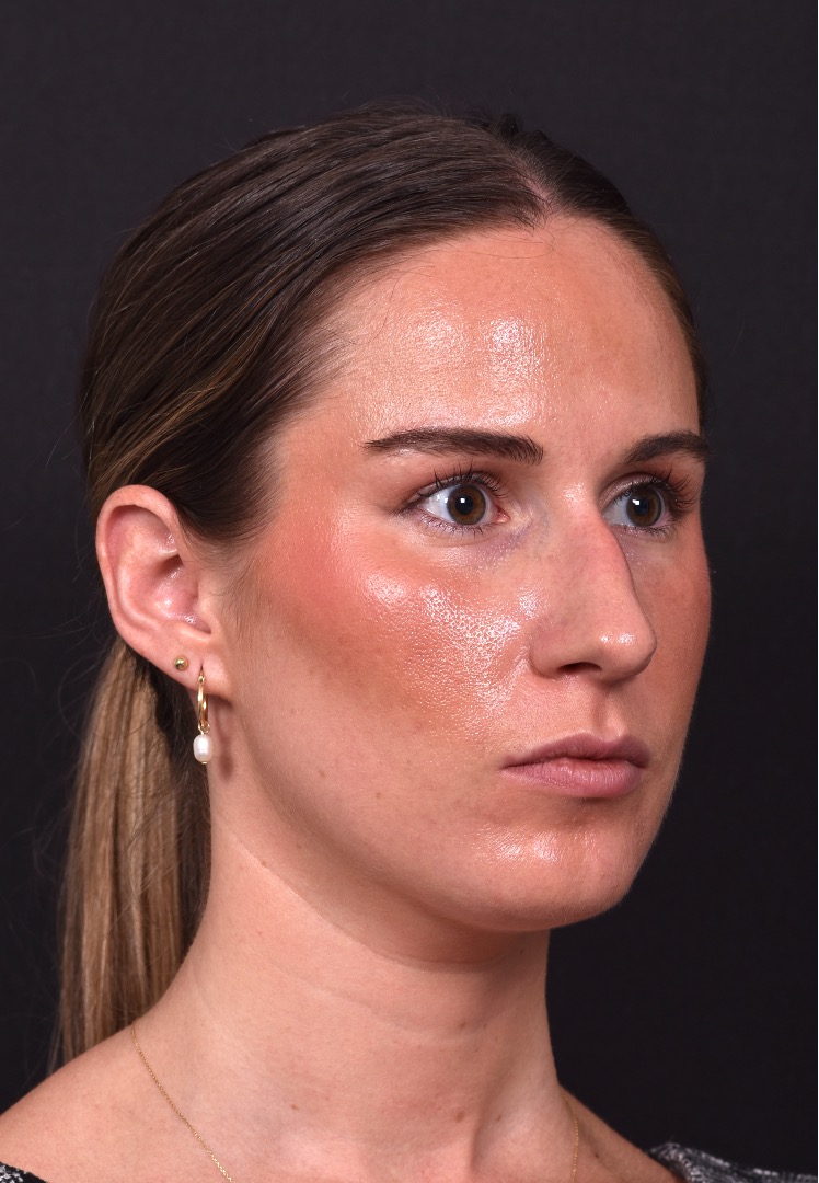 Rhinoplasty piezo ultrasonic preservation best expert near me Atlanta septoplasty nose job before after collagen