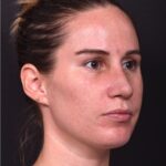 Rhinoplasty piezo ultrasonic preservation best expert near me Atlanta septoplasty nose job before after collagen