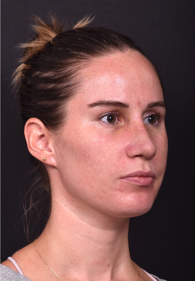 Rhinoplasty piezo ultrasonic preservation best expert near me Atlanta septoplasty nose job before after collagen