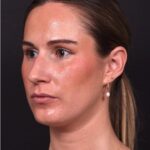 Rhinoplasty piezo ultrasonic preservation best expert near me Atlanta septoplasty nose job before after collagen