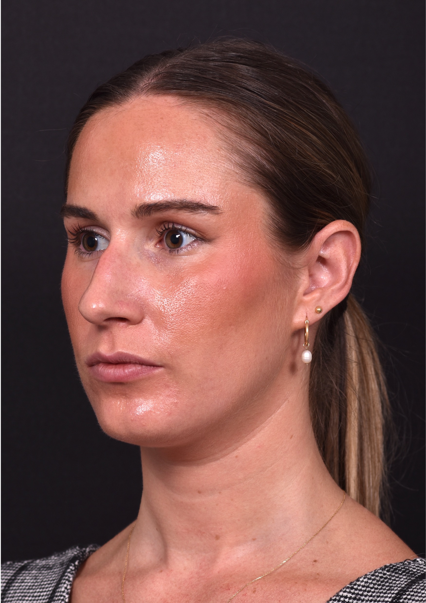 Rhinoplasty piezo ultrasonic preservation best expert near me Atlanta septoplasty nose job before after collagen