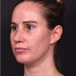 Rhinoplasty piezo ultrasonic preservation best expert near me Atlanta septoplasty nose job before after collagen