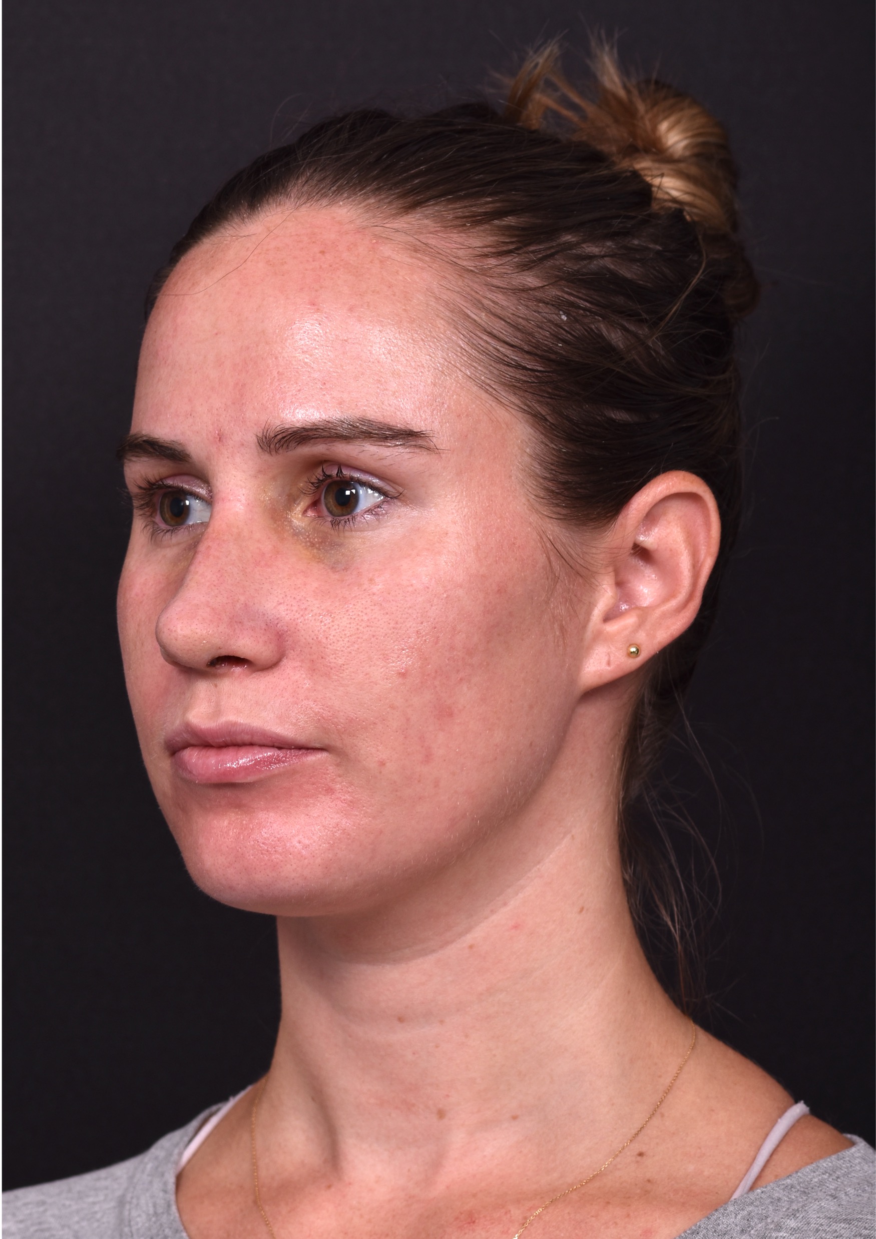 Rhinoplasty piezo ultrasonic preservation best expert near me Atlanta septoplasty nose job before after collagen