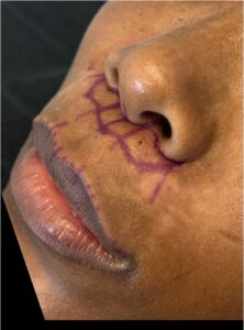 Liplift lip lift near me bullhorn Atlanta best expert female plastic surgeon results before and after collagen