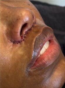 Liplift lip lift near me bullhorn Atlanta best expert female plastic surgeon results before and after collagen