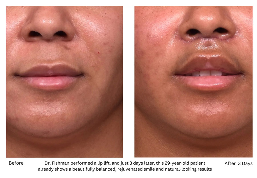 Dr. Fishman performed a lip lift, and just 3 days later, this 29-year-old patient already shows a beautifully balanced, rejuvenated smile and natural-looking results