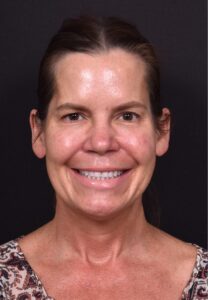 Eyelid lift blepharoplasty best expert near me before after results recovery female collagen Atlanta