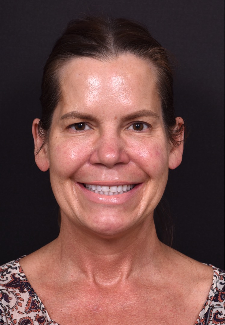 Eyelid lift blepharoplasty best expert near me before after results recovery female collagen Atlanta