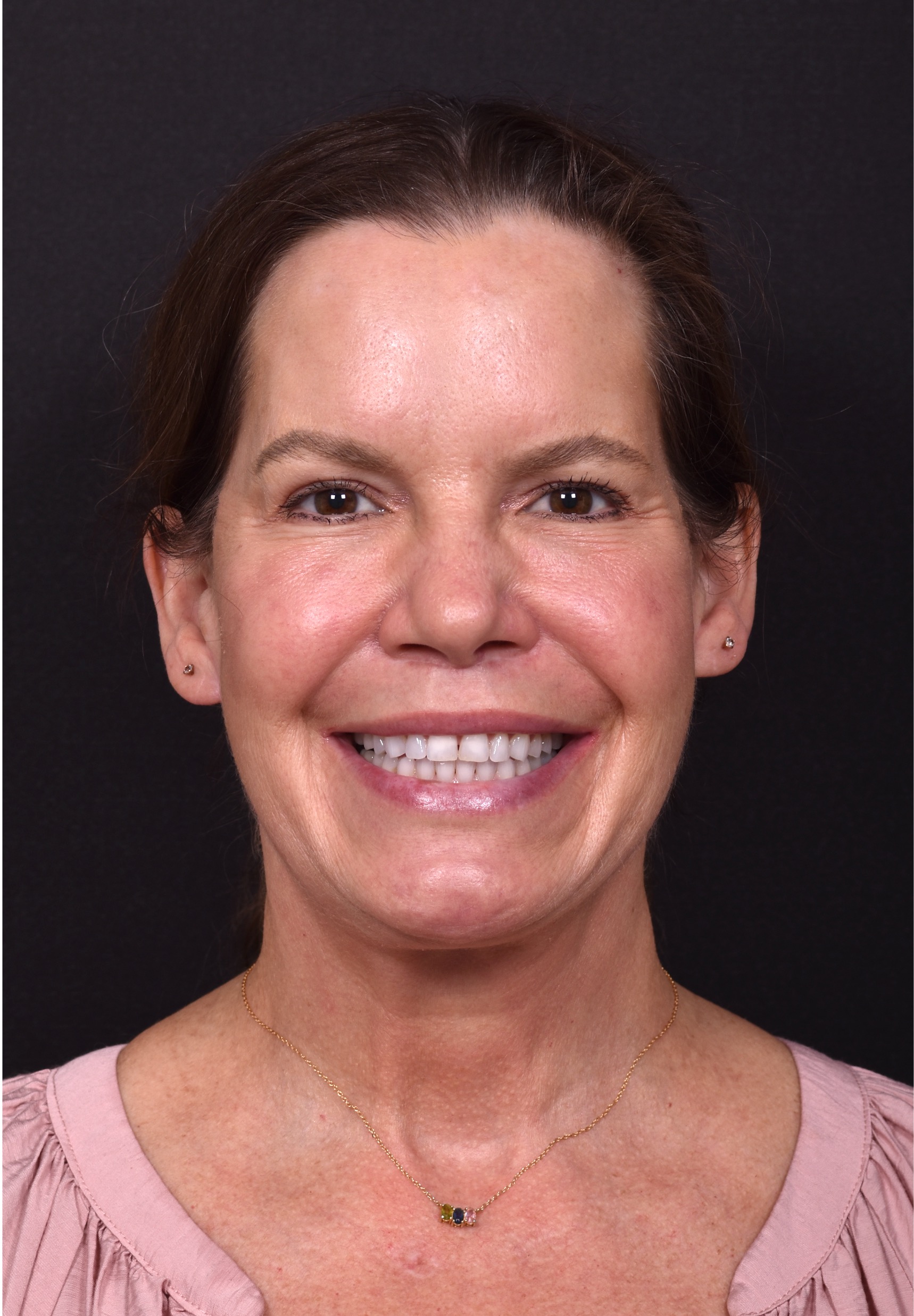 Eyelid lift blepharoplasty best expert near me before after results recovery female collagen Atlanta