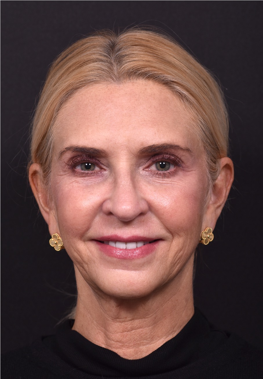 Atlanta facelift near me neck lift deep plane best expert female plastic surgeon detailed collagen tightening