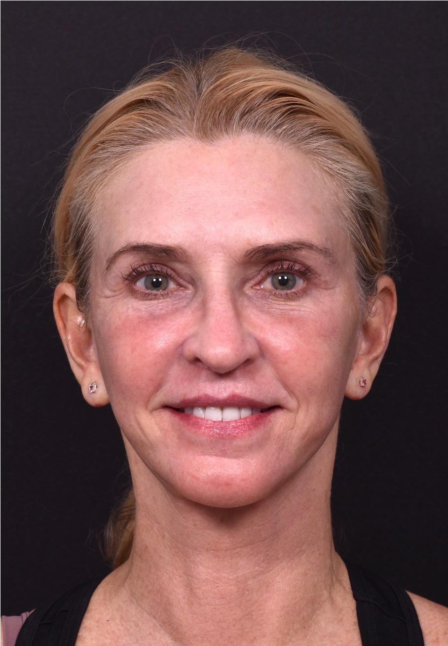 Atlanta facelift near me neck lift deep plane best expert female plastic surgeon detailed collagen tightening