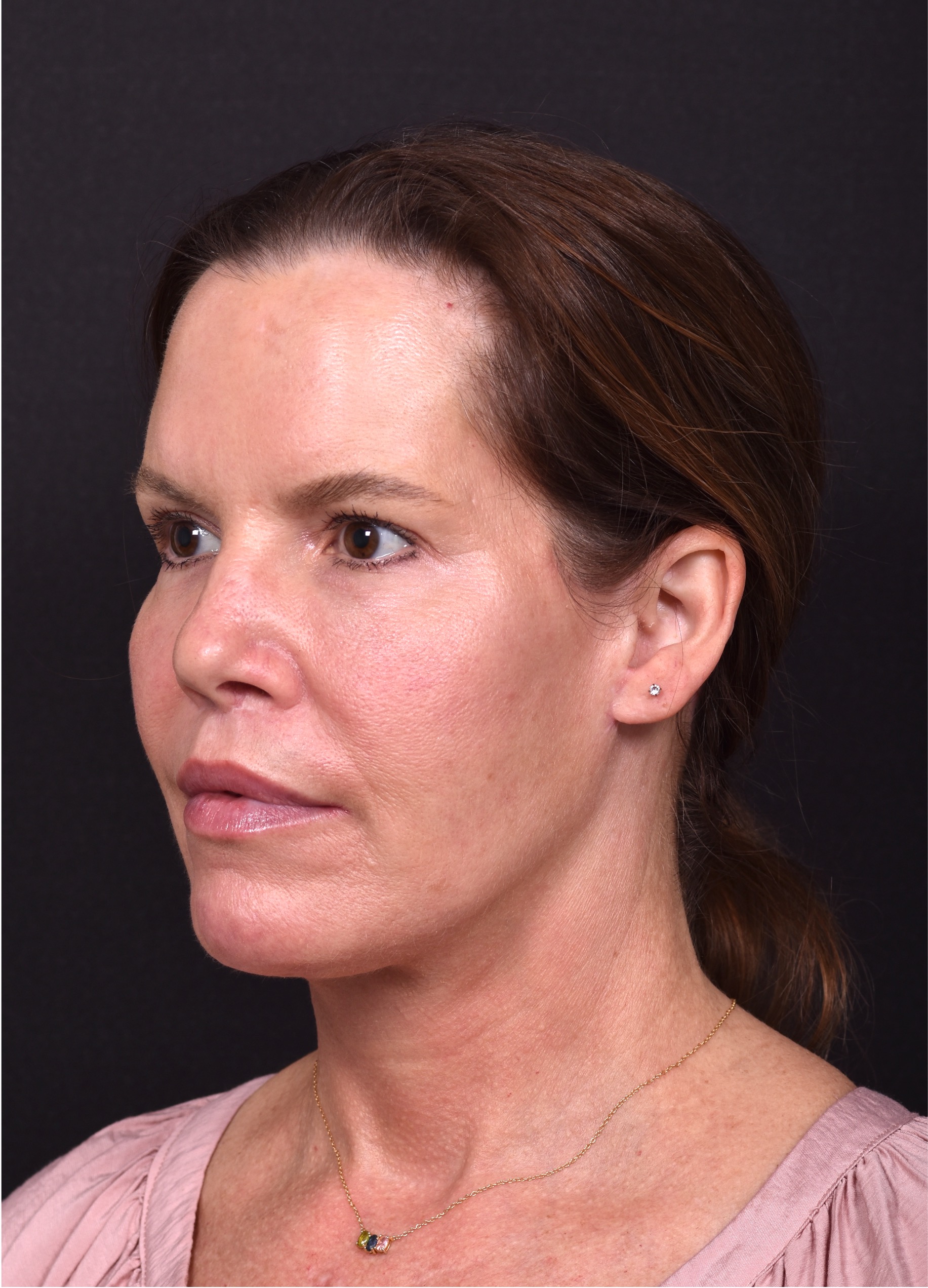 Facelift necklift deep plane results before after best expert near me recovery female Atlanta collagen