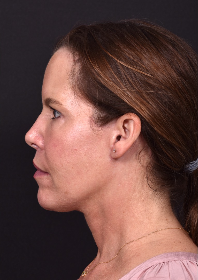 Facelift necklift deep plane results before after best expert near me recovery female Atlanta collagen