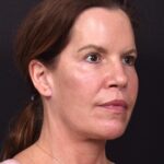 Facelift necklift deep plane results before after best expert near me recovery female Atlanta collagen