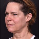 Deep plane facelift necklift peel collagen Atlanta best expert near me plastic surgery