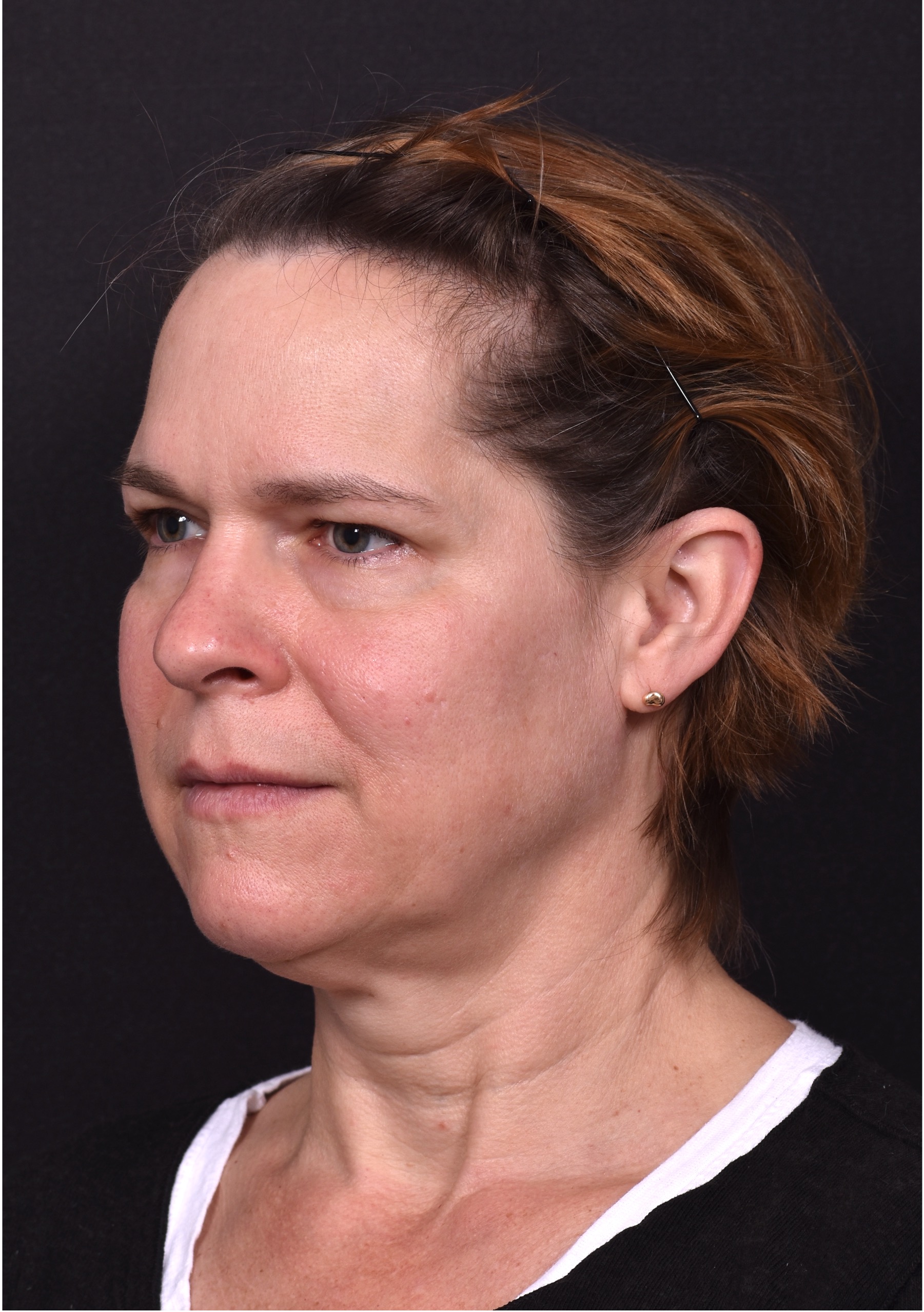 Deep plane facelift necklift peel collagen Atlanta best expert near me plastic surgery