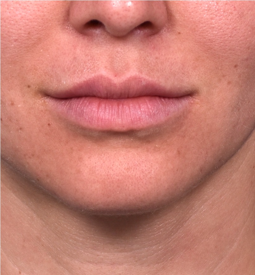 Lip lift before and after corner bullhorn best expert near me collagen Atlanta smile facial balancing