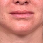 Lip lift before and after corner bullhorn best expert near me collagen Atlanta smile facial balancing