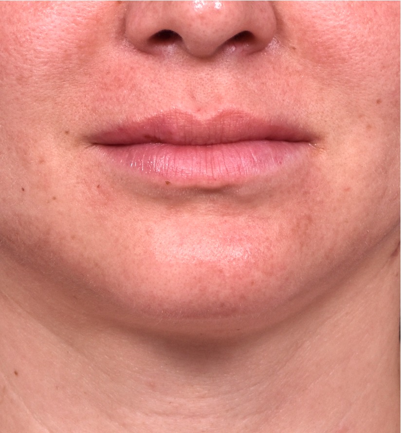 Lip lift before and after corner bullhorn best expert near me collagen Atlanta smile facial balancing