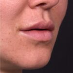 Lip lift before and after corner bullhorn best expert near me collagen Atlanta smile facial balancing
