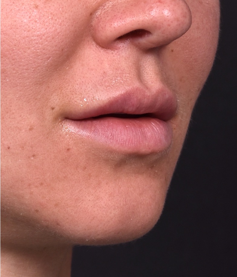 Lip lift before and after corner bullhorn best expert near me collagen Atlanta smile facial balancing