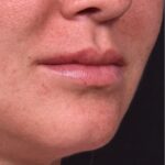 Lip lift before and after corner bullhorn best expert near me collagen Atlanta smile facial balancing