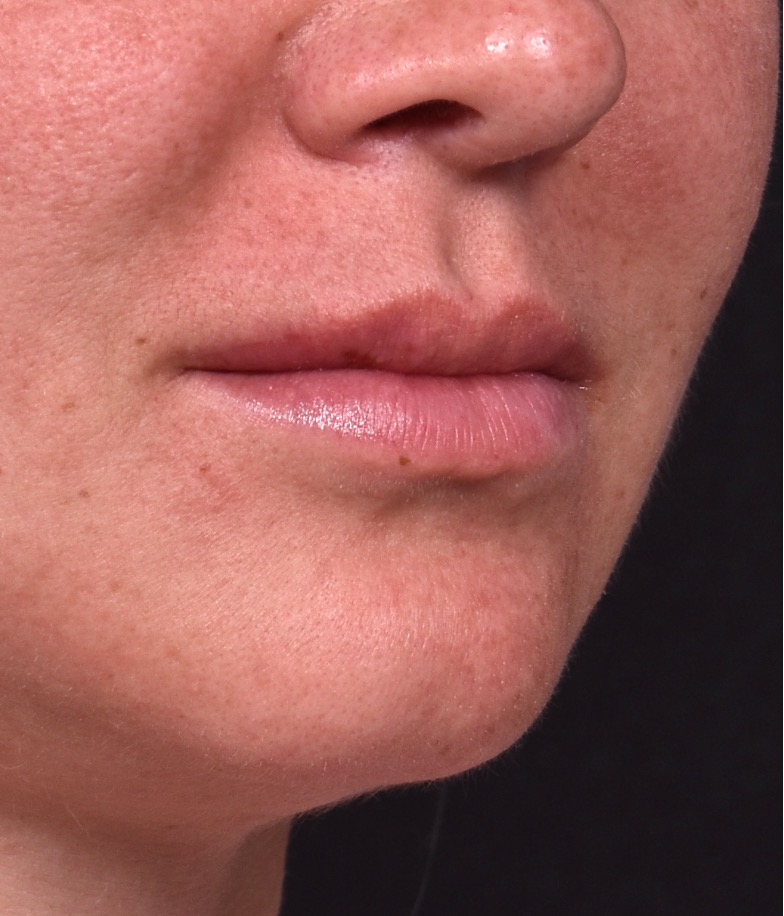 Lip lift before and after corner bullhorn best expert near me collagen Atlanta smile facial balancing