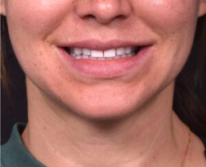 Lip lift before and after corner bullhorn best expert near me collagen Atlanta smile facial balancing