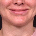 Lip lift before and after corner bullhorn best expert near me collagen Atlanta smile facial balancing