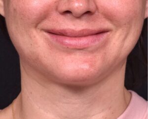 Lip lift before and after corner bullhorn best expert near me collagen Atlanta smile facial balancing