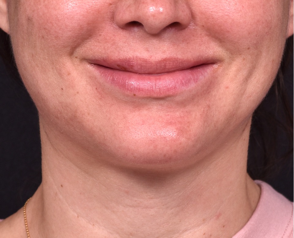 Lip lift before and after corner bullhorn best expert near me collagen Atlanta smile facial balancing