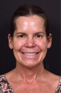 Atlanta lip lift bullhorn upper filler facial balance before after results recovery best expert near me collagen