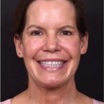 Atlanta lip lift bullhorn upper filler facial balance before after results recovery best expert near me collagen