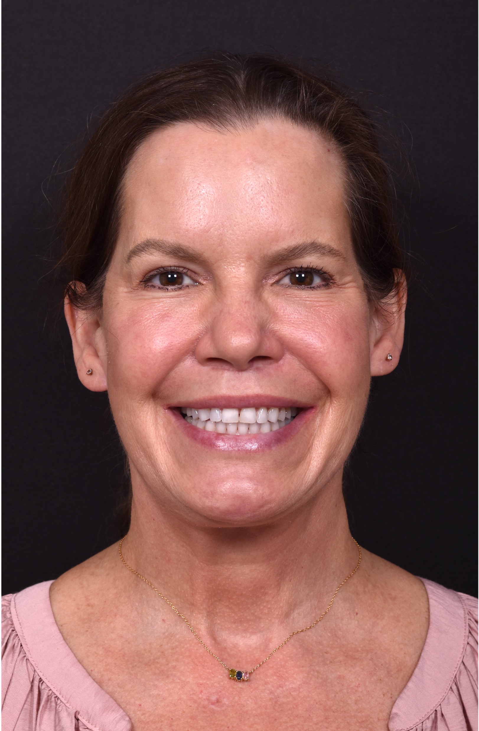 Atlanta lip lift bullhorn upper filler facial balance before after results recovery best expert near me collagen