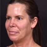 Atlanta lip lift bullhorn upper filler facial balance before after results recovery best expert near me collagen