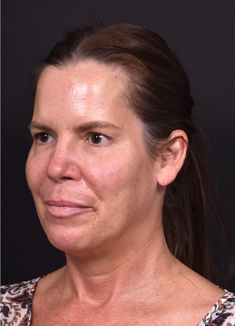 Atlanta lip lift bullhorn upper filler facial balance before after results recovery best expert near me collagen