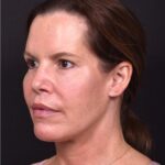 Atlanta lip lift bullhorn upper filler facial balance before after results recovery best expert near me collagen