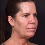 Atlanta lip lift bullhorn upper filler facial balance before after results recovery best expert near me collagen