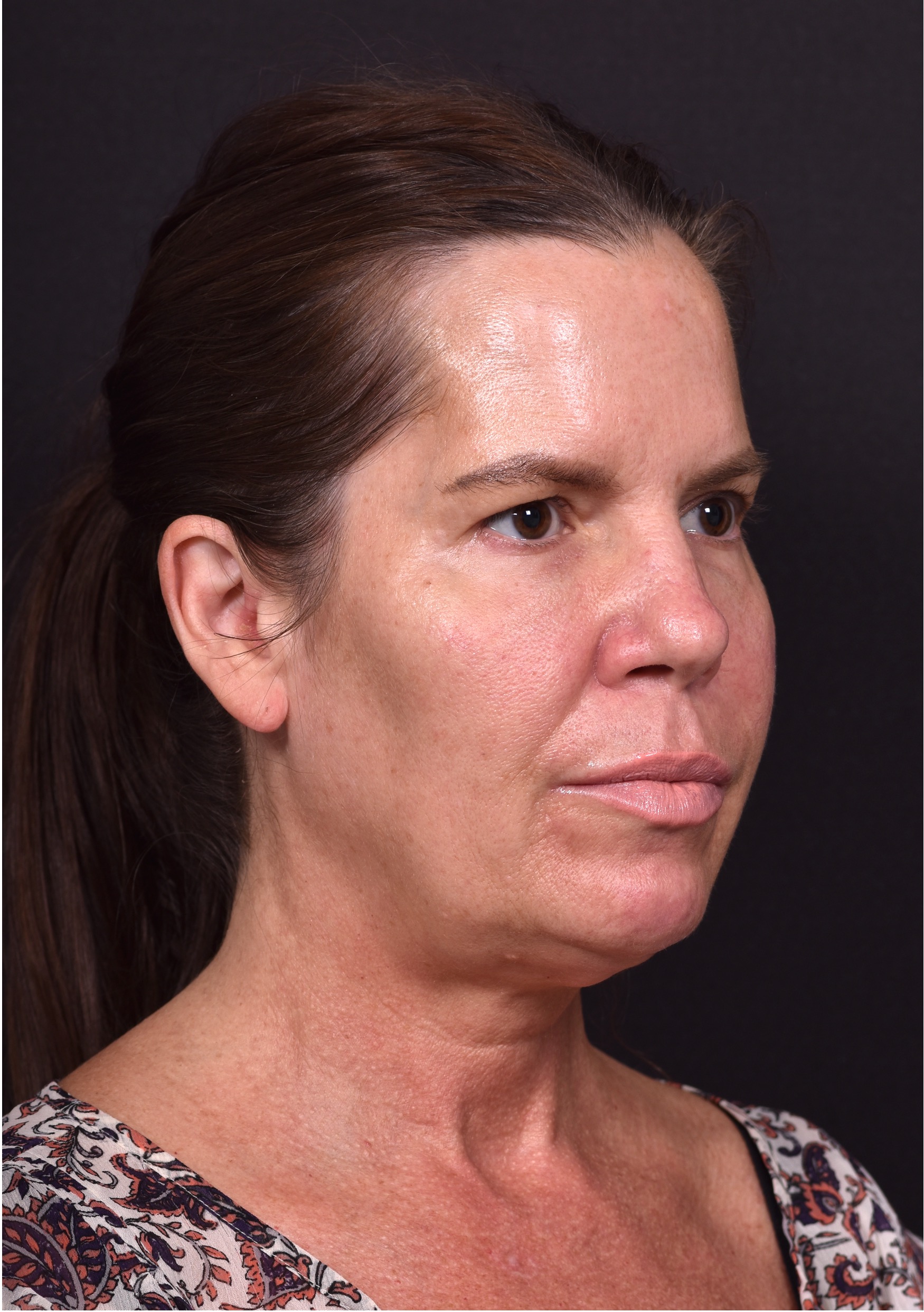 Atlanta lip lift bullhorn upper filler facial balance before after results recovery best expert near me collagen