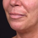 Atlanta lip lift bullhorn upper filler facial balance before after results recovery best expert near me collagen