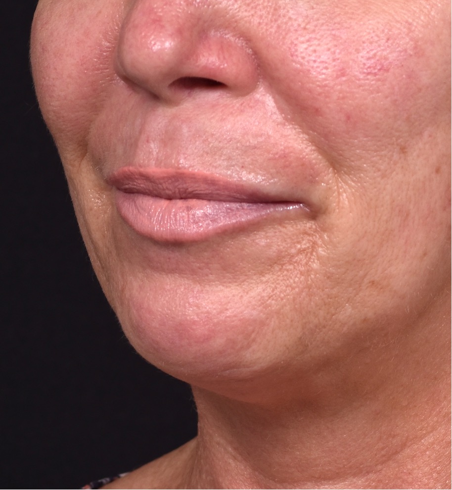 Atlanta lip lift bullhorn upper filler facial balance before after results recovery best expert near me collagen