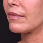 Atlanta lip lift bullhorn upper filler facial balance before after results recovery best expert near me collagen