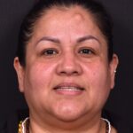 Atlanta osteoma forehead knot bump bone lipoma scarless female plastic surgeon collagen